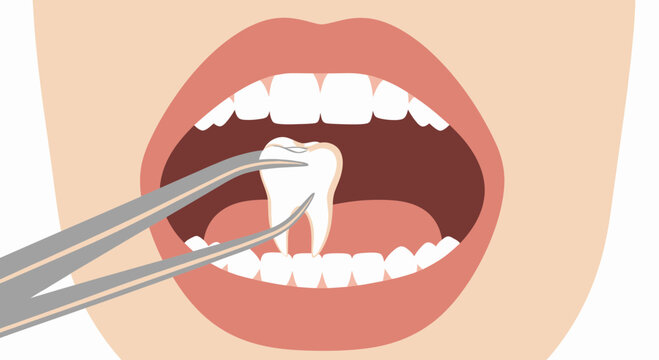 Tooth Extraction with Dental Forceps