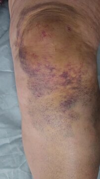 Bruising and swelling on the knee observed after injury during sports activity in the afternoon