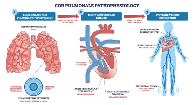 Cor pulmonale pathophysiology shows how lung disease leads to pulmonary hypertension, right ventricular failure, and venous congestion, key objects, lungs, heart, body silhouette. Outline diagram