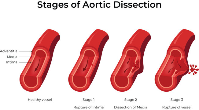 Stages of Aortic Dissection Medical Design Vector Illustration