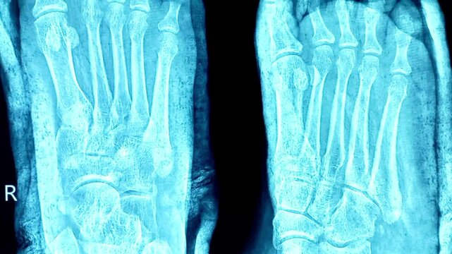 X-ray of the human right foot. Fracture noted at base of 5th metatarsal bone. 