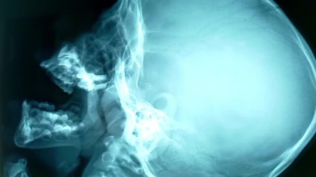 X-ray of the human nasopharynx. Adenoids (grade-II).