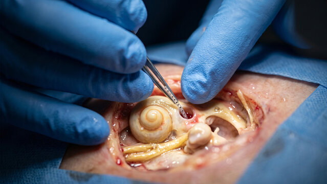 Extreme Macro of Surgeon Inserting Cochlear Implant into Inner Ear