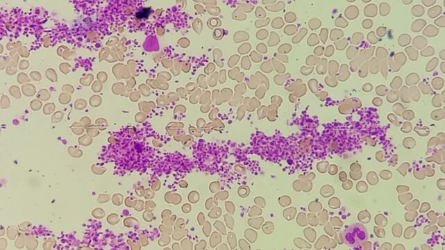 Normocytic normochromic anaemia with leucocytosis and thrombocytosis. Microscopic footage of blood cells. 