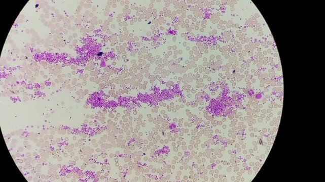 Normocytic normochromic anaemia with leucocytosis and thrombocytosis. Microscopic footage of blood cells. 
