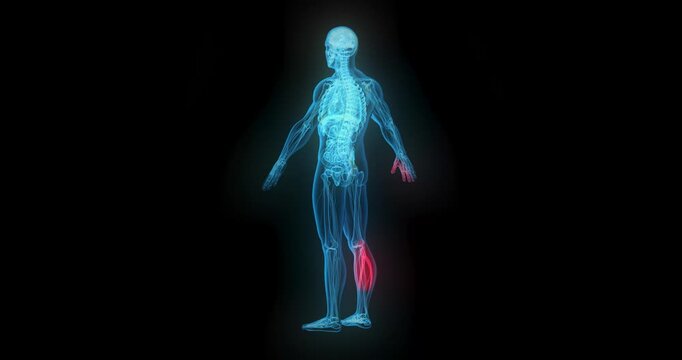 4k Resolution Video: Medical Diagnosis And Pain Detection Concept. Transparent Human Skeleton With Animate Glowing Red Illness Zones Highlighting Internal Inflammation On Black Background
