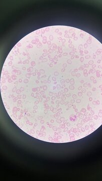 schistocyte
