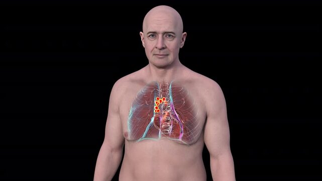 Pulmonary lymphadenitis visualised within transparent thoracic anatomy of adult male body, enlarged inflamed lymph nodes highlighted in rotating 3D medical animation.