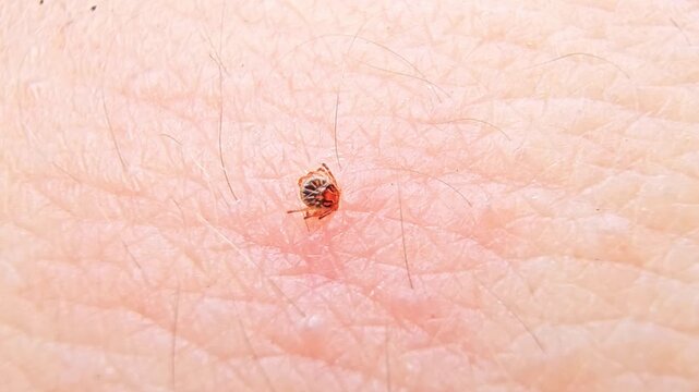 Extreme close up of a blood sucking tick biting into human skin. This parasitic arachnid is a known vector for spreading lyme disease