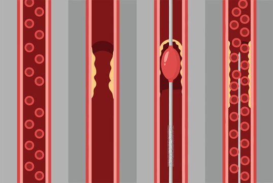 Angioplasty and stent placement procedure is illustrated in four steps showing the clearing of a blocked artery using a balloon.