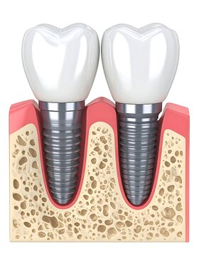 Dental implants with white tooth crowns.