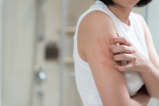 skin problem and beauty. Young woman scratch body has itchy skin from skin allergic, steroid allergy, sensitive skin, red from sunburn, chemical allergy, rash, insect bites, Seborrheic Dermatitis.