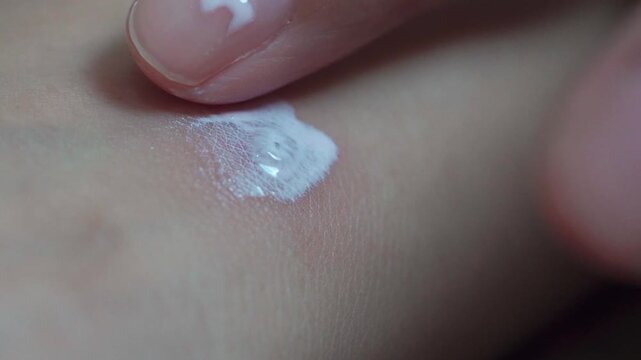 Close up of a chickenpox blister on human skin with red rash