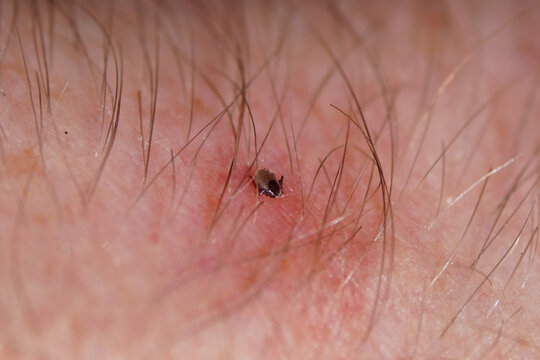 Nymph Castor bean tick, sheep ked, sheep tick, Ixodes ricinus sucks blood. On the skin of an arm. Family Ticks, Ixodidae. Spring, May, Netherlands.