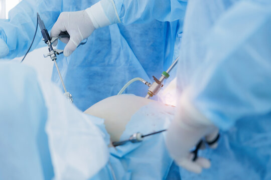 Operating team using laparoscopic camera and instruments in theater medical clinic