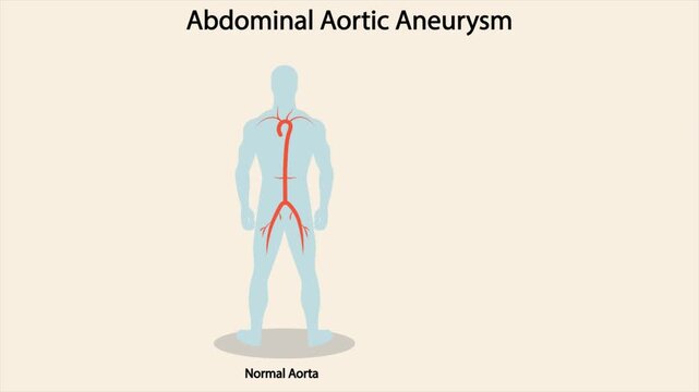Abdominal aortic aneurysm vector illustration showing enlarged abdominal artery with human body anatomy and vascular condition concept for medical education and healthcare animation.