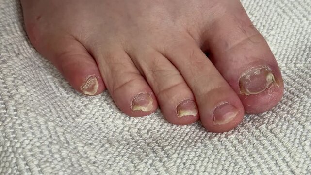 Toenail fungal infection closeup showing yellowed crumbling big toenail and surrounding toes on white carpet