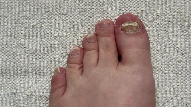 Toenail fungal infection closeup showing yellowed crumbling big toenail and surrounding toes on white carpet