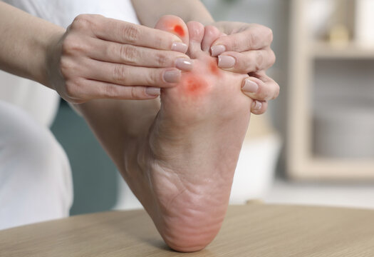 Woman with calluses on her foot at home, closeup