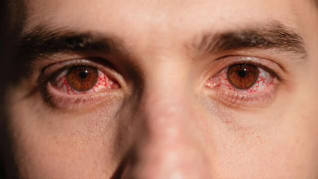 Keratitis is a common inflammatory eye disease that affects the cornea, often causing redness, soreness, blurred vision and eye irritation. Caused by bacterial, viral or fungal infections and external