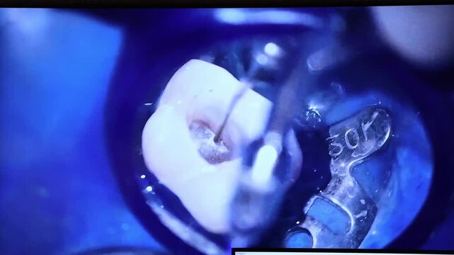 Tooth Cleaning With Dental Tools. Detailed View Of Tooth Treatment With Isolation And Suction