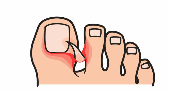 Close-up of a toes with a painful ingrown toenail and inflammation