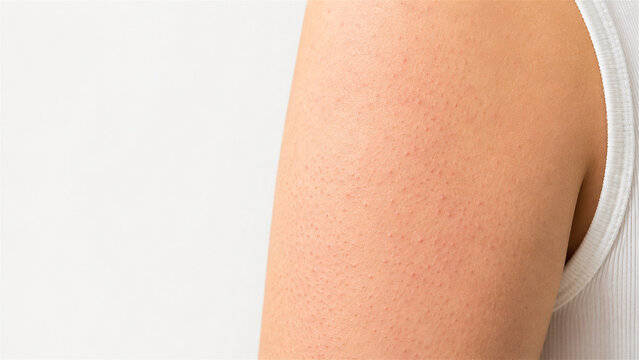 woman arm with keratosis pilaris showing skin texture and bumps. Medical dermatological condition on shoulder. Skin health problem and skincare concept for body treatment and dermatology