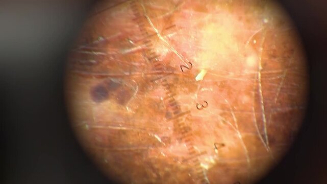 Oncology clinic. Warts on human skin. Skin cancer screening. Papillomas on human skin.