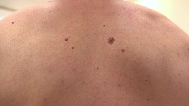 Oncology clinic. Warts on human skin. Skin cancer screening. Papillomas on human skin.