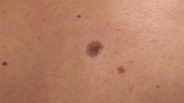 Oncology clinic. Warts on human skin. Skin cancer screening. Papillomas on human skin.