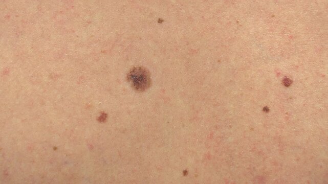 Oncology clinic. Warts on human skin. Skin cancer screening. Papillomas on human skin.