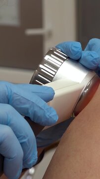 Oncology clinic. Warts on human skin. Skin cancer screening. Papillomas on human skin - Vertical video