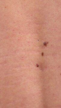 Oncology clinic. Warts on human skin. Skin cancer screening. Papillomas on human skin - Vertical video