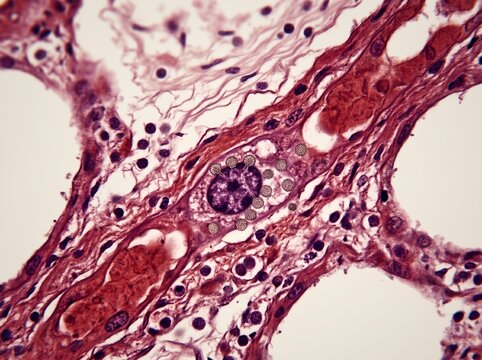 Hantavirus Inflamed Lung Tissue Macro Cross Section with Alveolar Pathology Detail