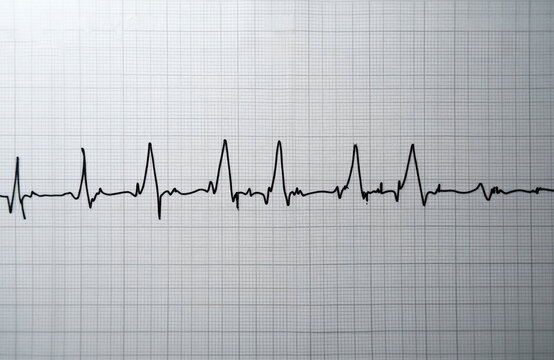 Electrocardiogram shows irregular heartbeat on graph paper. Wide QRS complex indicates potential ventricular arrhythmia tachycardia, requiring medical attention. Heart rhythm monitoring vital for