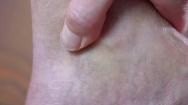 Person checking varicose veins on the foot. Close-up of a finger pressing on a swollen, bulging varicose vein on a person's foot, examining the vascular disease and problems with blood circulation