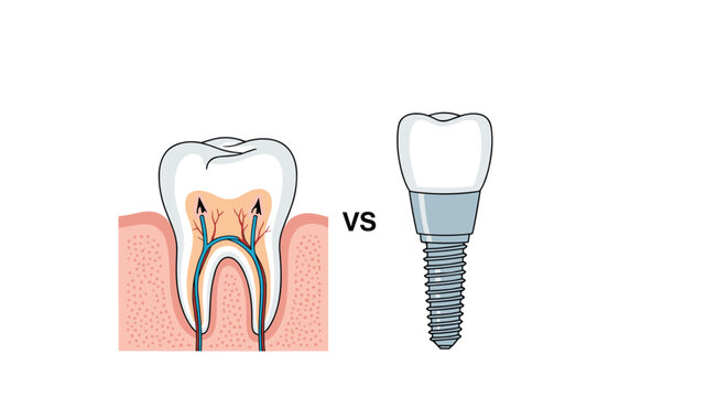 Medical comparison illustration showing a natural human tooth with roots and nerves versus a modern artificial metallic dental implant.