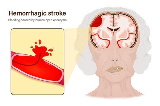 Hemorrhagic stroke. Bleeding caused by broken open aneurysm. Cerebral hemorrhage. Human brain anatomy structure.