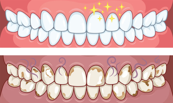 Teeth whitening before and after comparison, healthy clean smile versus dirty yellow calculus vector illustration