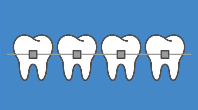 Four white teeth arranged in a row with silver dental braces attached in this clear illustration