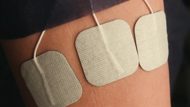 Patient undergoing physiotherapy with electrical stimulation in a medical center. Electrodes attached to the leg for pain relief, muscle recovery and rehabilitation after injury. High quality 4k
