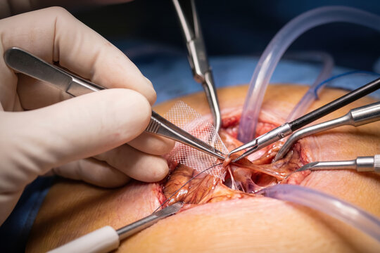 Surgical hernia repair procedure using reinforcement mesh and medical instruments