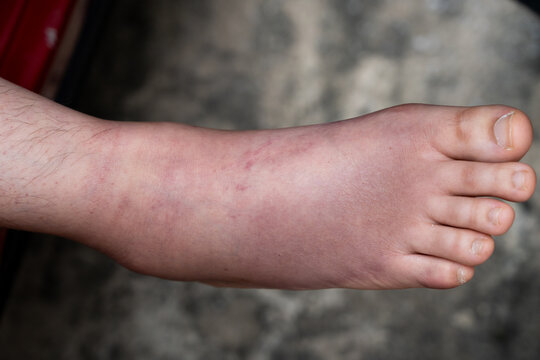 Swollen Foot After Cast Removal of Metatarsal Fracture