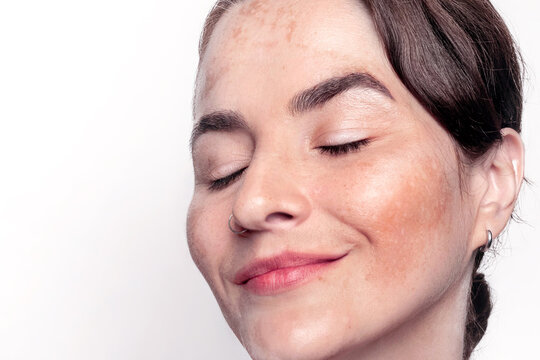 Pretty woman face with pigmentation, melasma, freckles, age spots skin problem. Smile girl