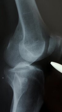 Doctor radiologically analyzing the knee with x-ray
Hand of a doctor analyzing and pointing with a pen to the affected area.