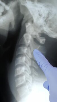 Doctor radiologically analyzing the neck spinal column with x-ray.
Glove hand of a doctor analyzing and pointing with a pen to the affected area.