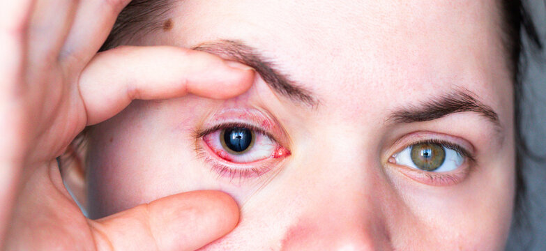 Conjunctivitis making eye bloodshot and swollen. Patient at ophthalmology clinic. Doctor using enlarges pupil drops for diagnosis. Eye infection treatment with antibacterial drops