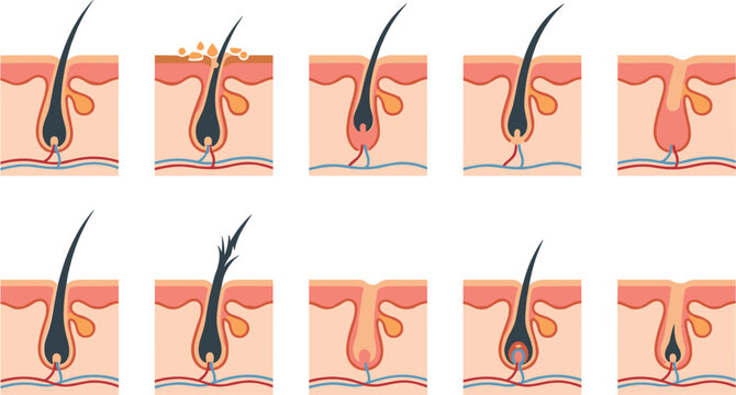 Human Hair Follicle Anatomy and Growth Cycle Vector Icon Set Showing Anagen Catagen Telogen Stages Hair Loss and Scalp Skin Care Diagram Elements
