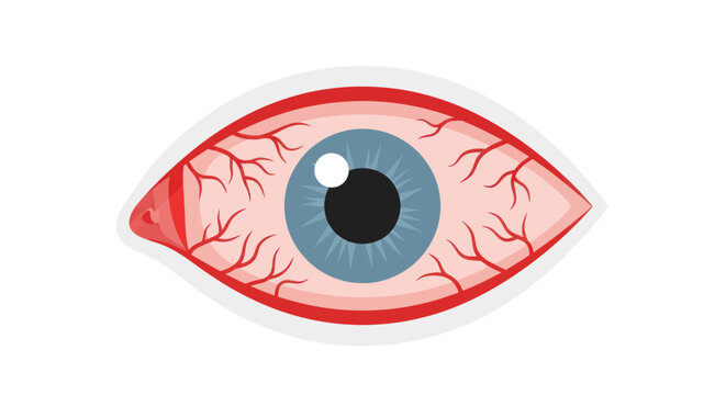 Red Irritated Eye with Visible Blood Vessels - Medical Illustration