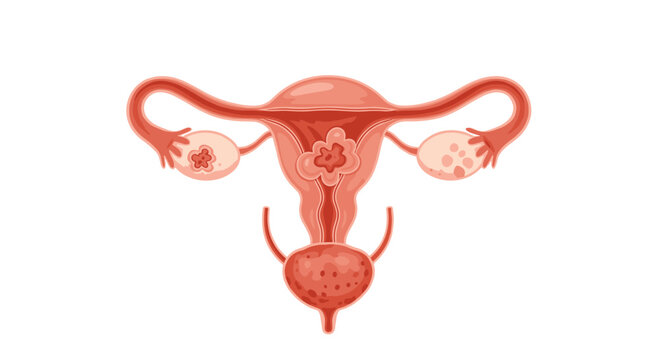 Medical illustration of the female reproductive system showing conditions like fibroids or cysts in the uterus.